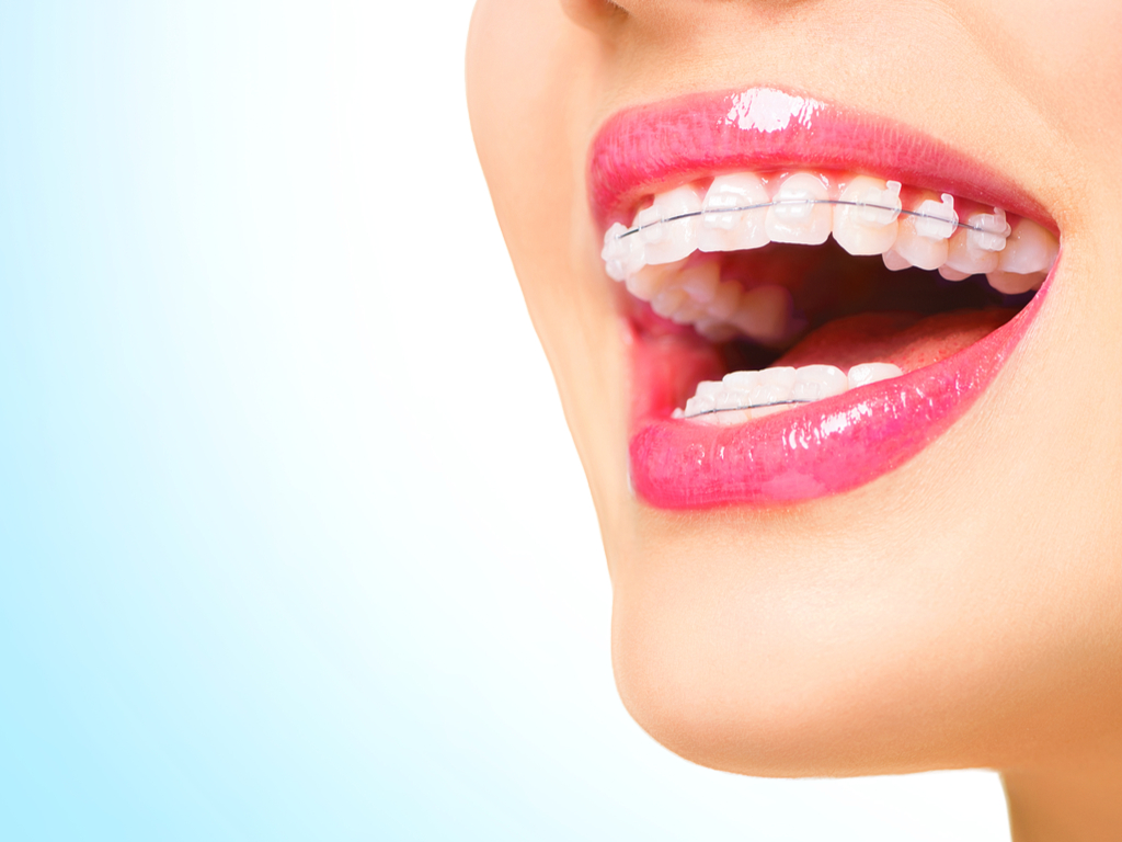 Teeth Whitening - 3 Ways Stay Clear Of Teeth Whitening Disasters